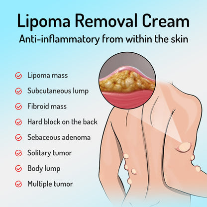 Lipoma Removal Cream Relief Pain Treat Skin Swelling Lipolysis Cellulite Fat Lump Nodule Removal Ointment Anti-tumor Plaster