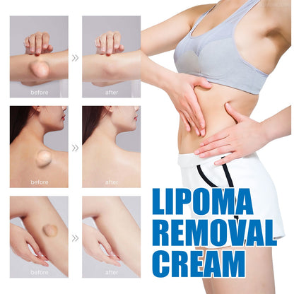 Lipoma Removal Cream Relief Pain Treat Skin Swelling Lipolysis Cellulite Fat Lump Nodule Removal Ointment Anti-tumor Plaster
