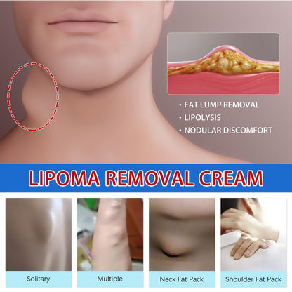 Lipoma Removal Cream Relief Pain Treat Skin Swelling Lipolysis Cellulite Fat Lump Nodule Removal Ointment Anti-tumor Plaster